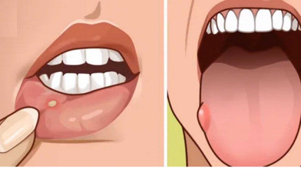 Behçet hastalığı nedir? Behçet hastalığı kim buldu? Hulusi Behçet kimdir?